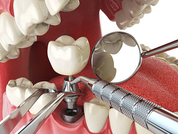 Best Emergency Tooth Extraction in Hernando, FL